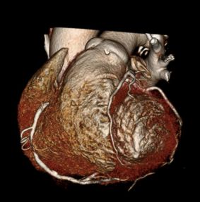 Heart CT Screening