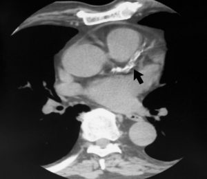 Severe Calcification