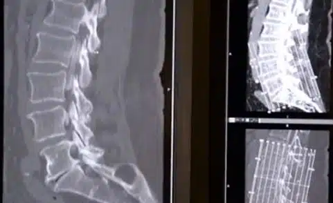 What It’s Like to Get a Myelogram